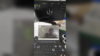 Έγχρωμο Doppler τρόλεϊ Διαγνωστικό σύστημα υπερήχων BR-US01